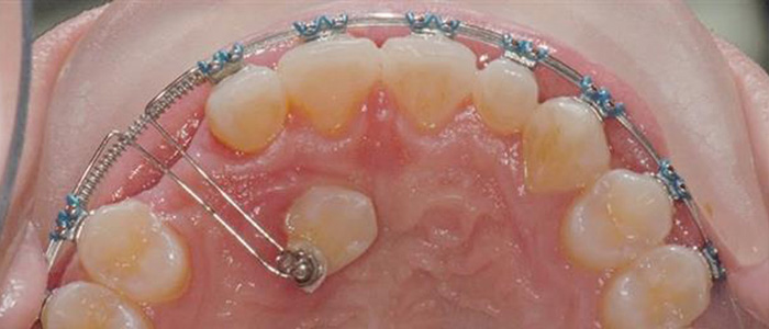 انواع روش های ارتودنسی تک دندان